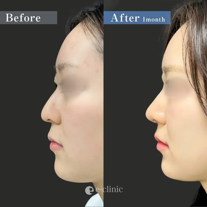 鼻尖形成3D法 ＋耳介軟骨移植（名医の服部健人医師が執刀）