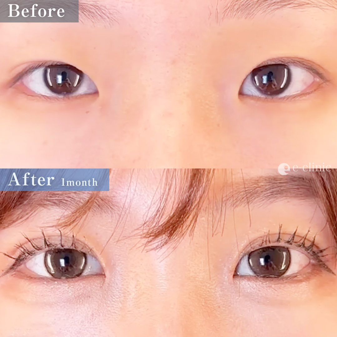 自然癒着法＋目頭切開（名医の島田良浩医師が執刀）