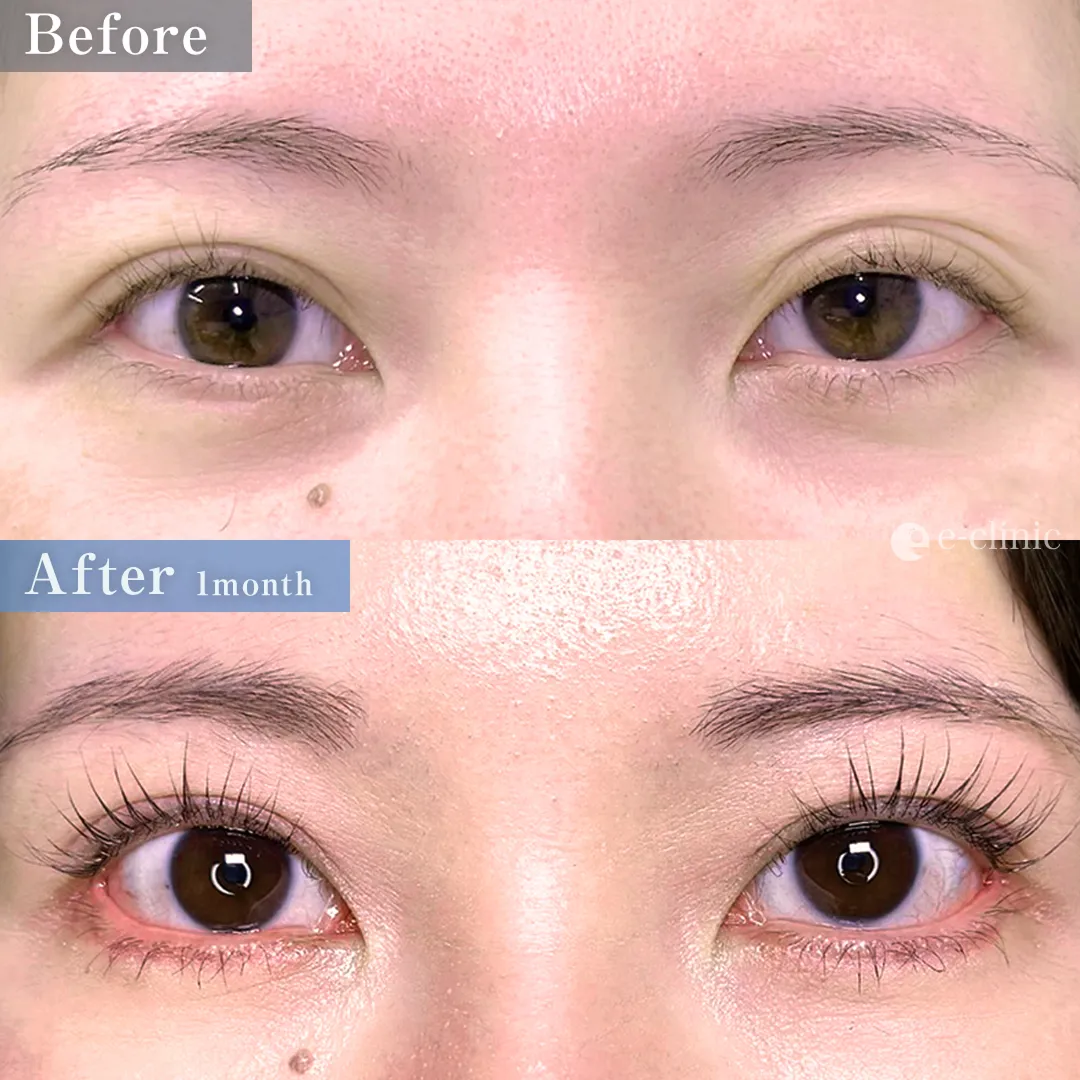 目尻切開＋タレ目形成（名医の坂本医師が執刀）