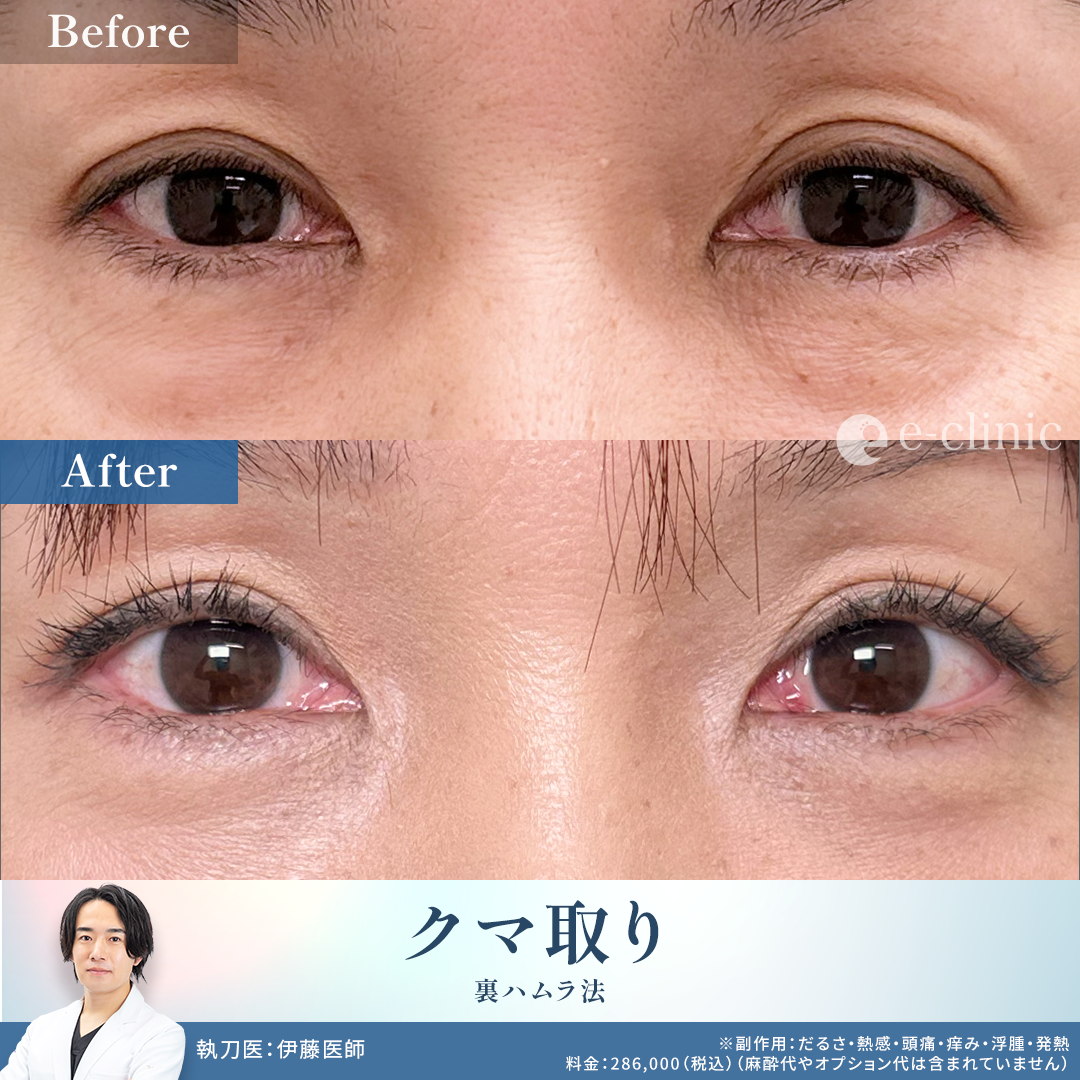 クマ取りの裏ハムラの症例写真