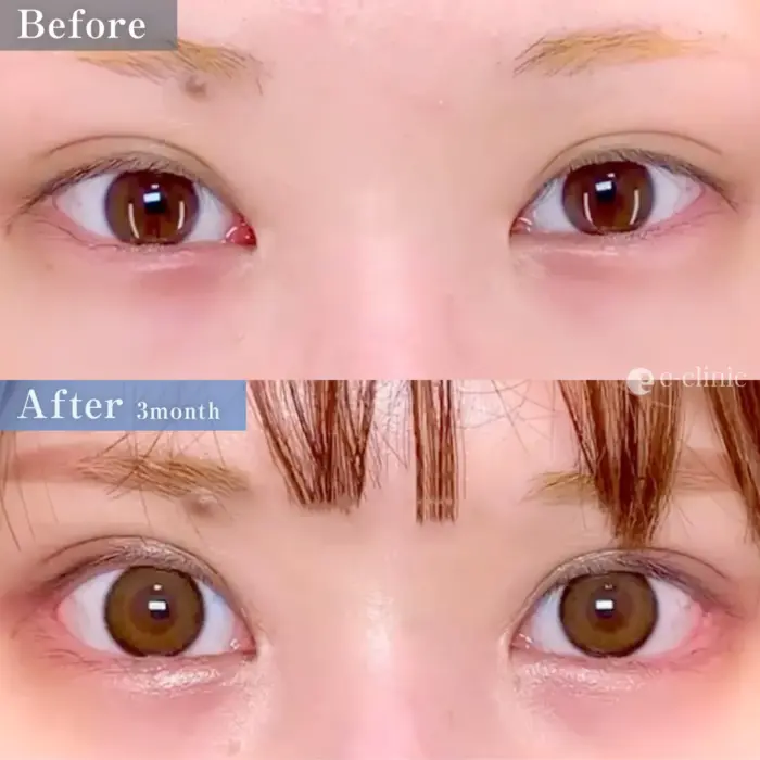 グラマラスラインの他院修正（目尻切開＋タレ目形成）（名医の円戸望医師が執刀）