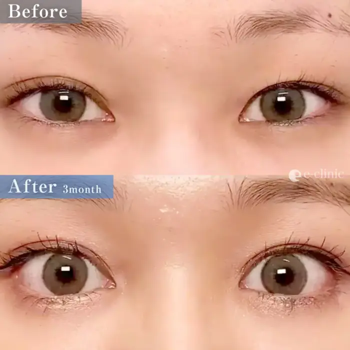 グラマラスライン（目尻切開＋タレ目形成）（名医の円戸望医師が執刀）