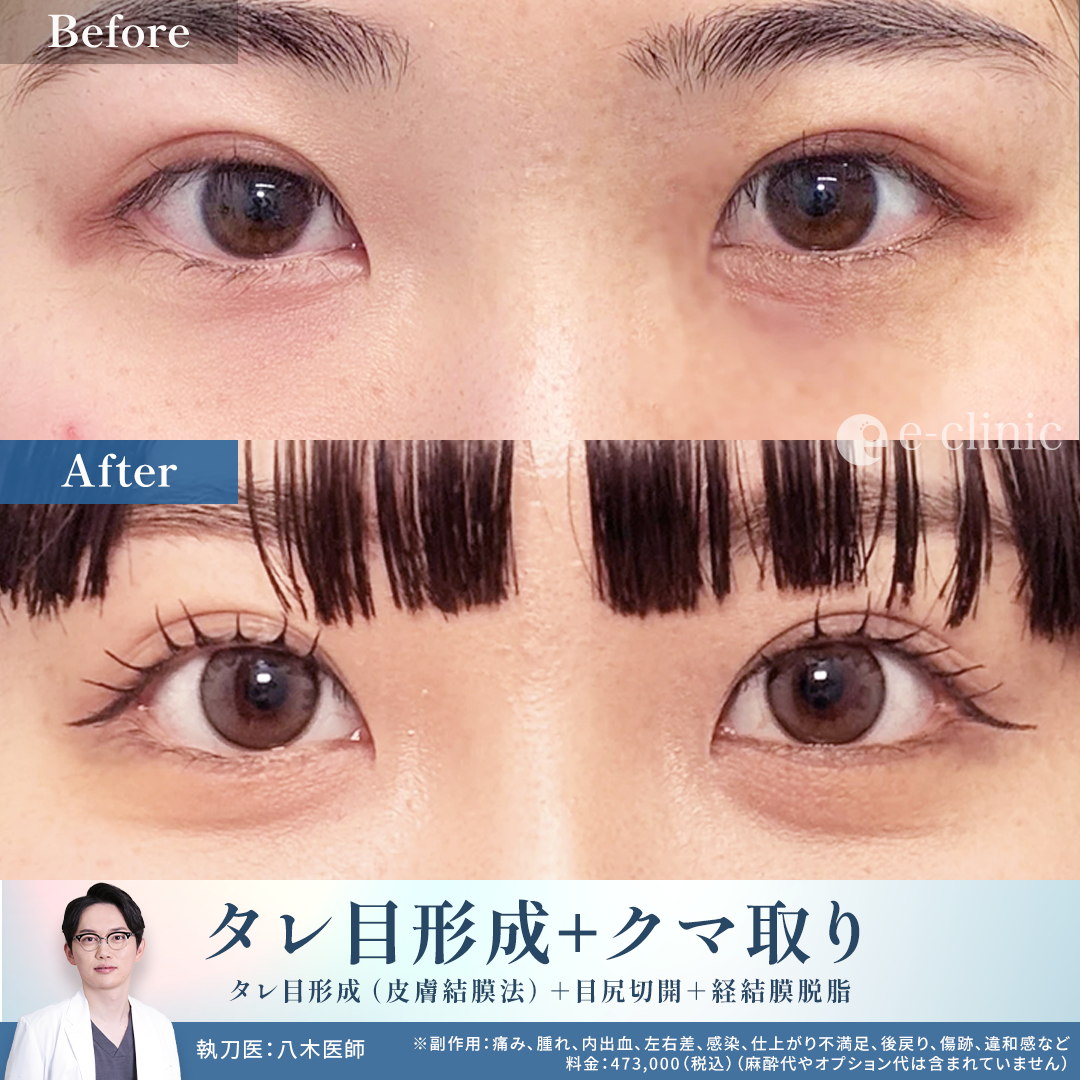 タレ目形成と目尻切開と経結膜脱脂の症例写真