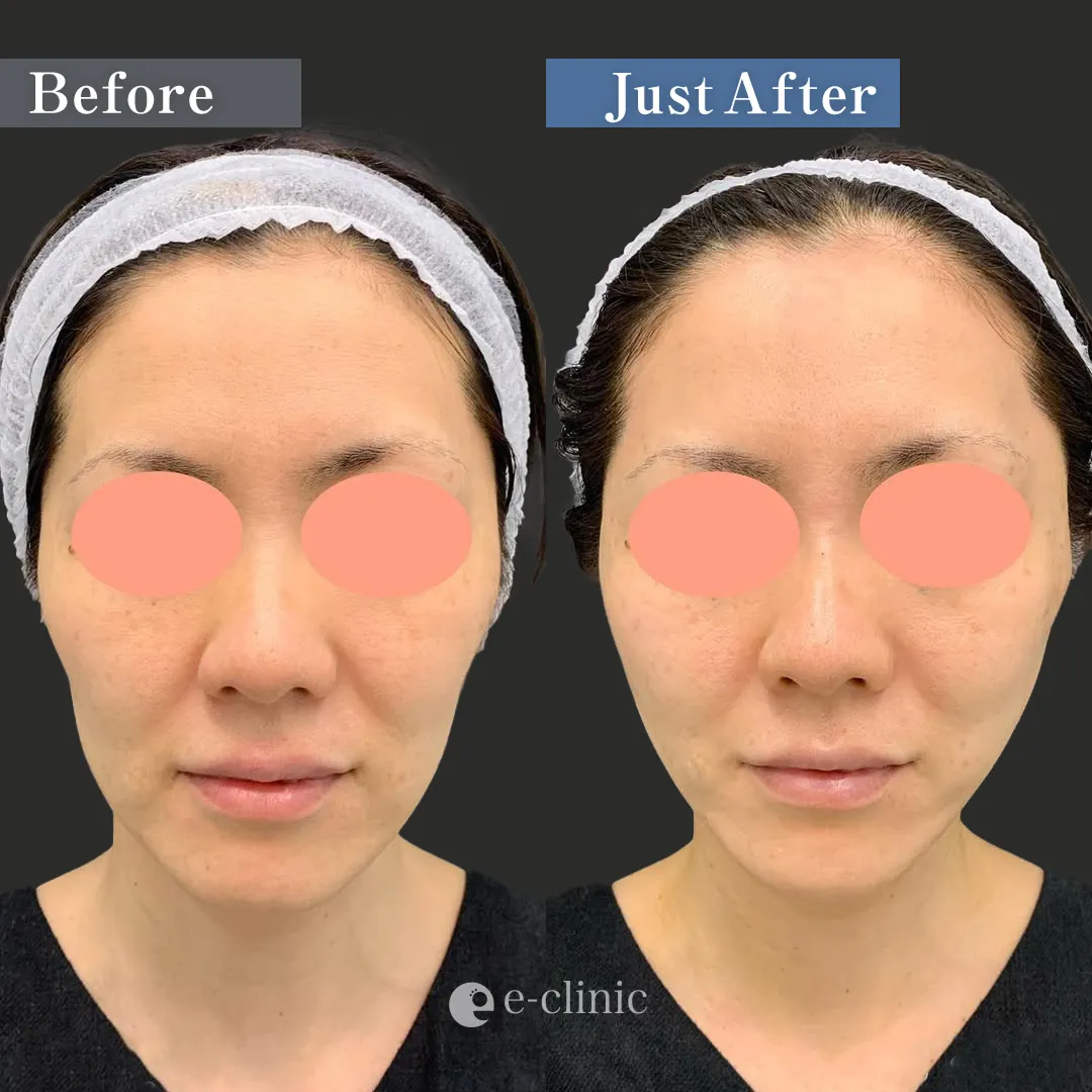 ハイブリッドフェイスリフト（名医の張田医師が執刀）