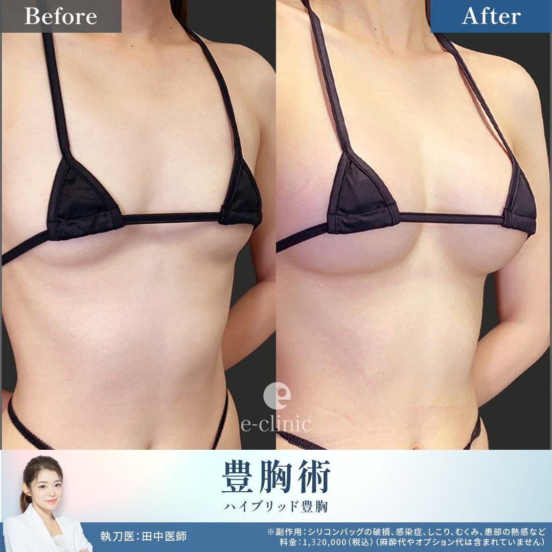 ハイブリッド豊胸手術の症例写真