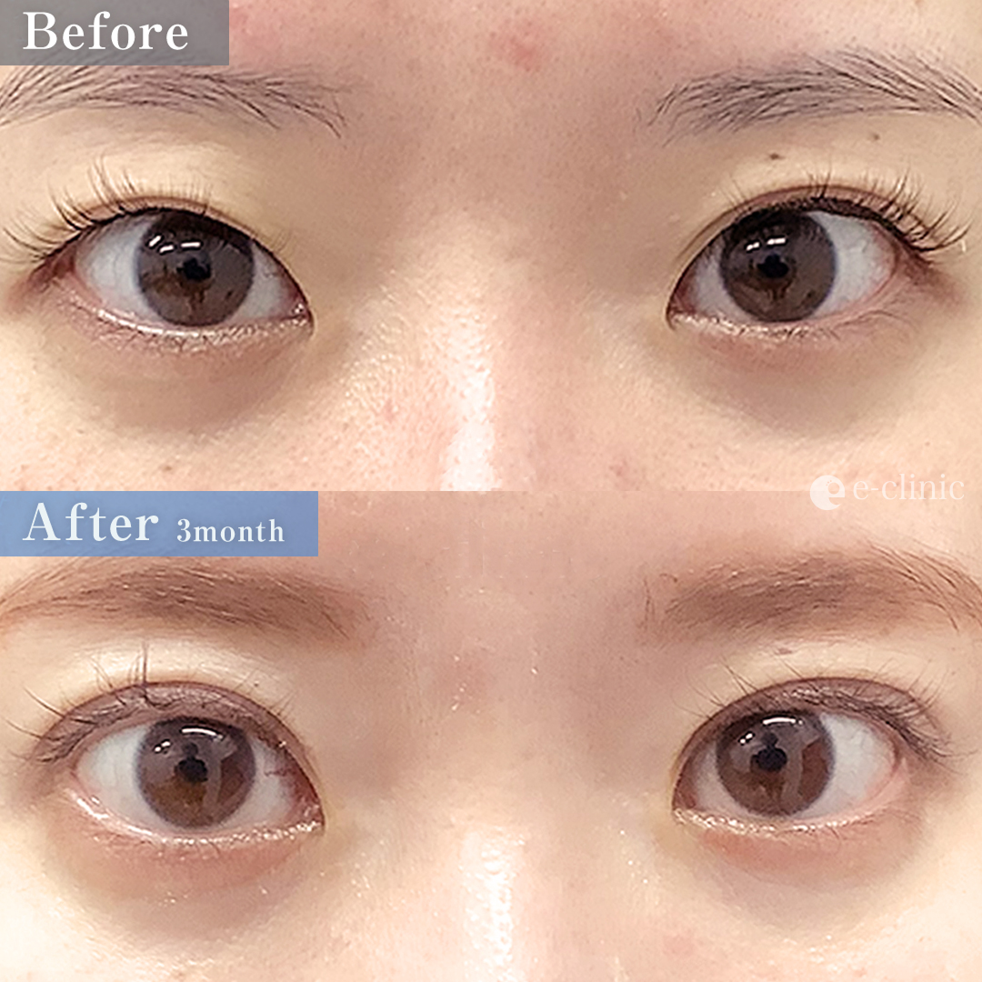 全切開二重＋埋没抜糸（名医の飯田医師が執刀）