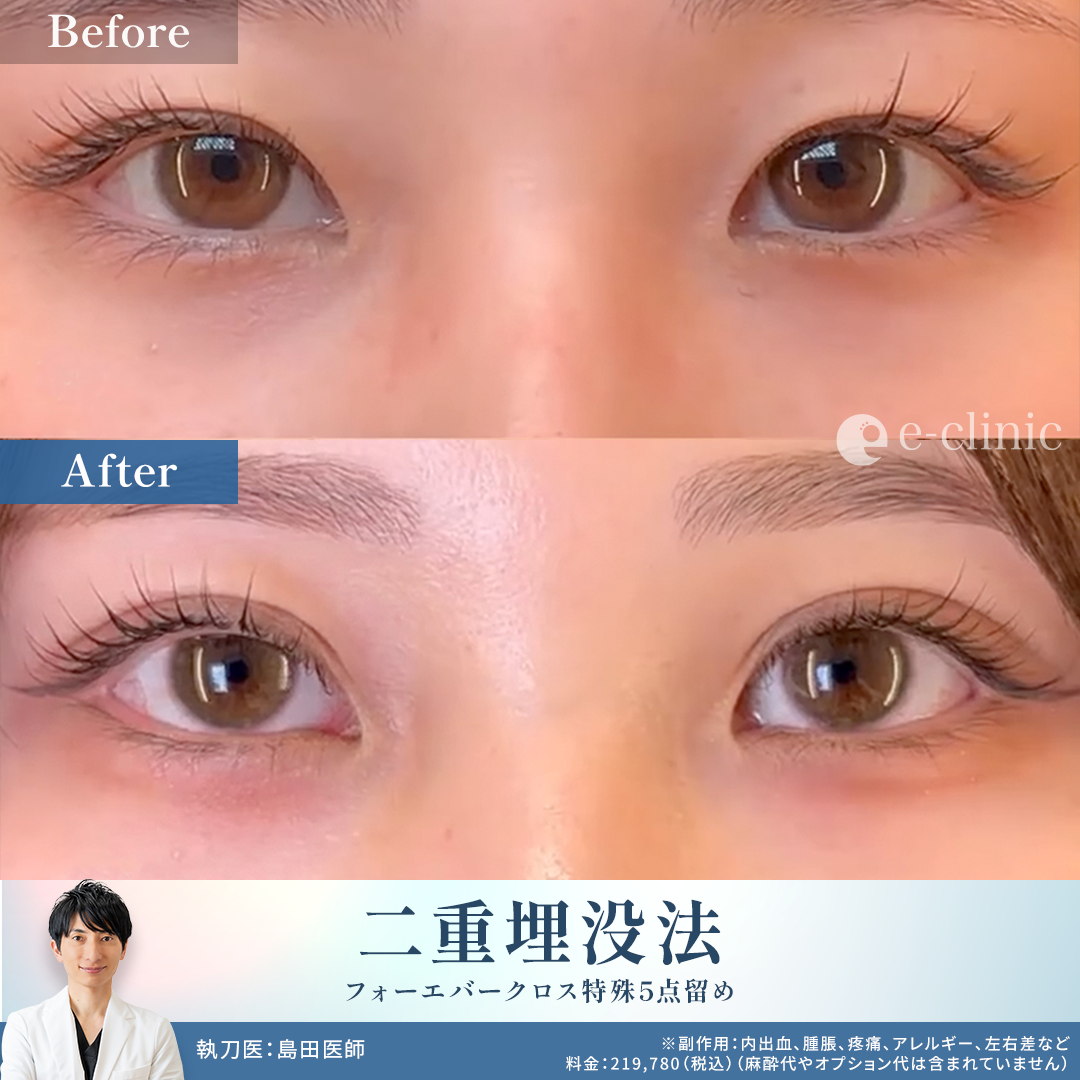 埋没法の症例写真