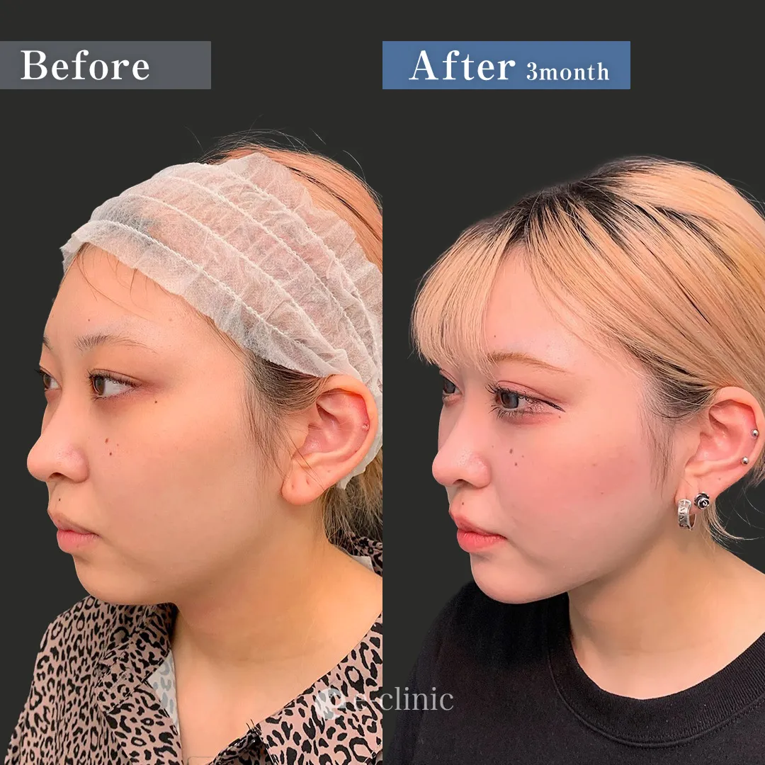 小顔フルセット（名医の張田医師が執刀）