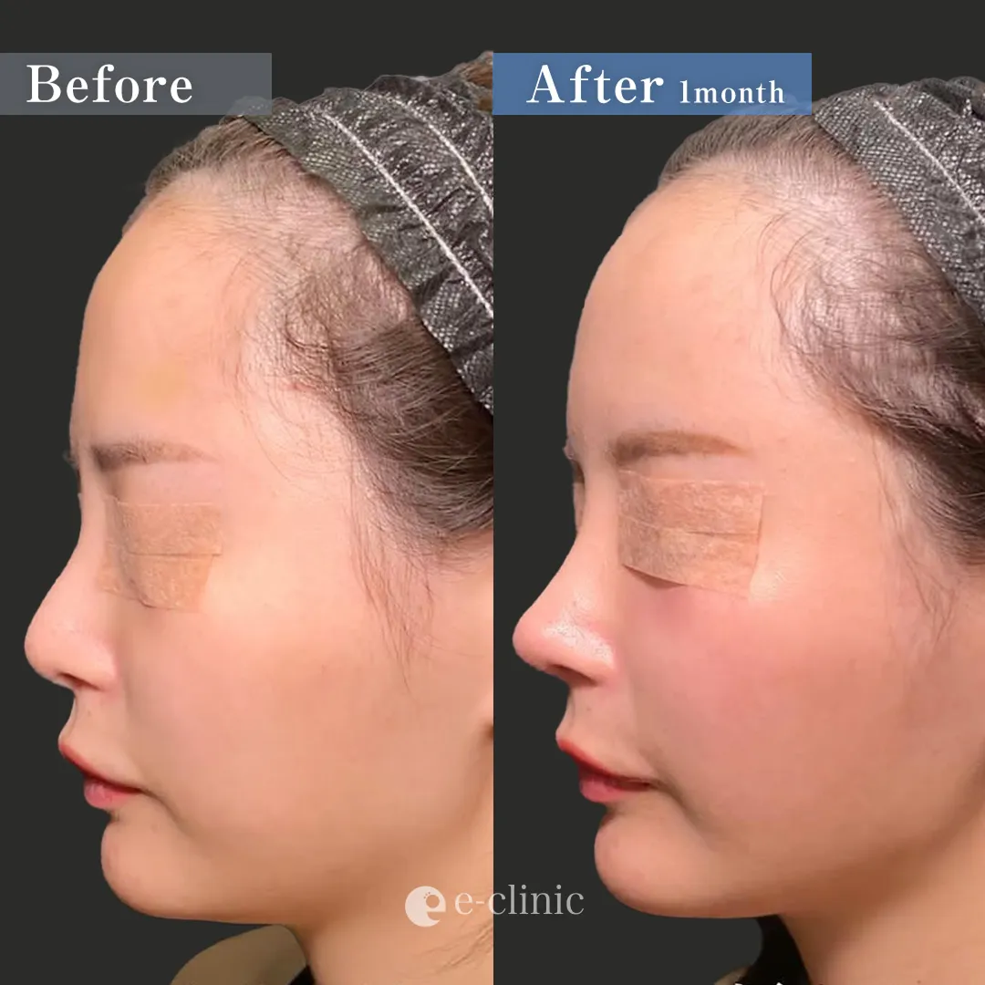 小顔フルセット＋鼻フルセット（名医の張田医師が執刀）