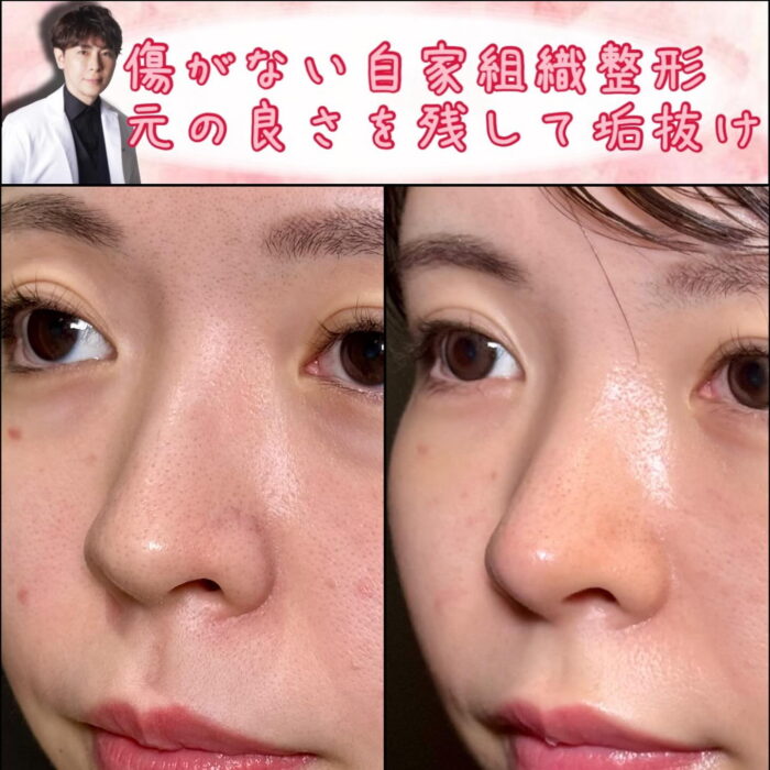 斜め右から見たクローズド法の鼻尖形成と軟骨移植の症例写真