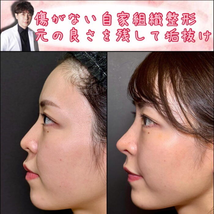 横から見たクローズド法の鼻尖形成と軟骨移植の症例写真