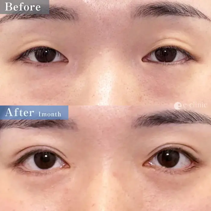 自然癒着法＋目頭切開＋たれ目形成（皮膚結膜法）＋目尻切開＋裏ハムラ（名医の八木医師が執刀）