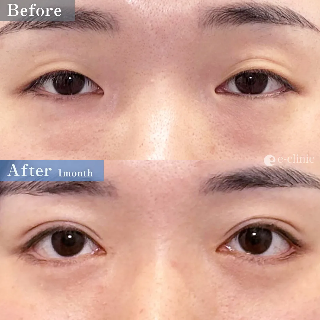 自然癒着法＋目頭切開＋たれ目形成（皮膚結膜法）＋目尻切開＋裏ハムラ（名医の八木医師が執刀）