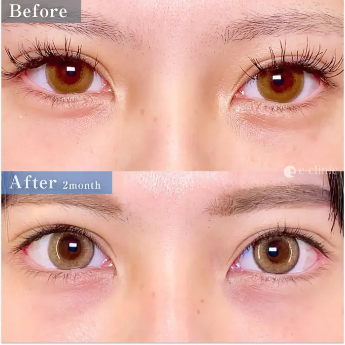 目尻切開（目尻靭帯移動）＋タレ目（グラマラス）形成（（皮膚＋結膜など）＋目尻靱帯移動　（名医の円戸望医師が執刀）