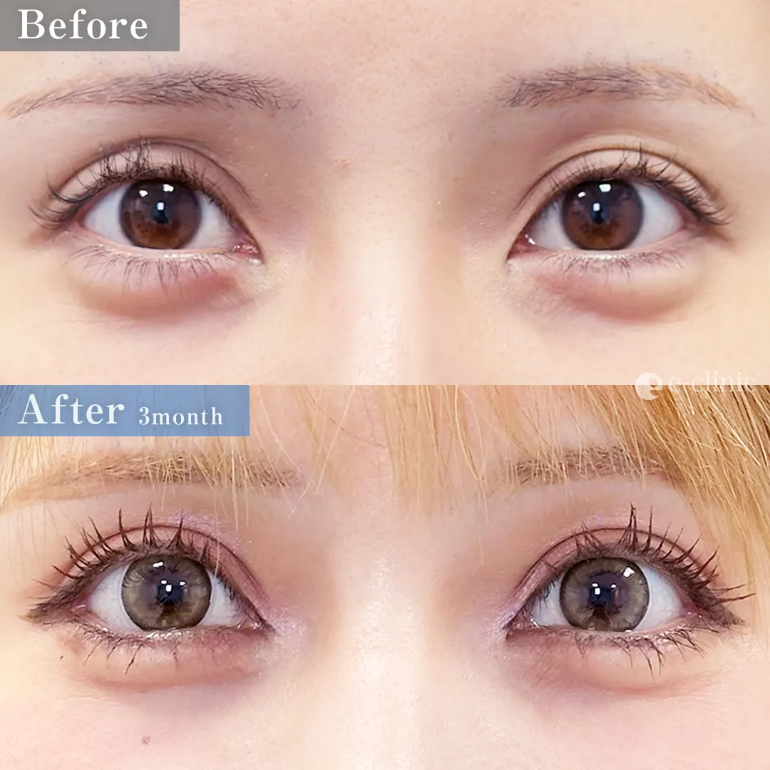 目尻切開＋タレ目形成（名医の服部医師が執刀）