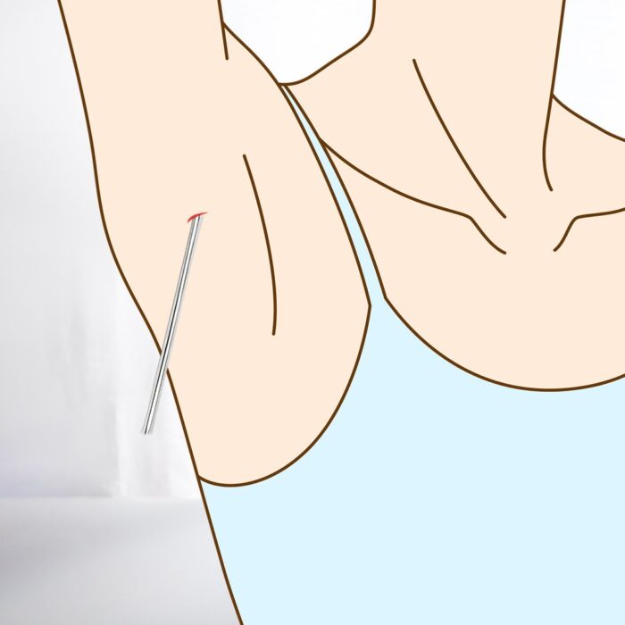 脇からアポクリン汗腺を吸引しているところ