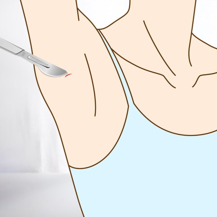 脇にメスを入れているところ