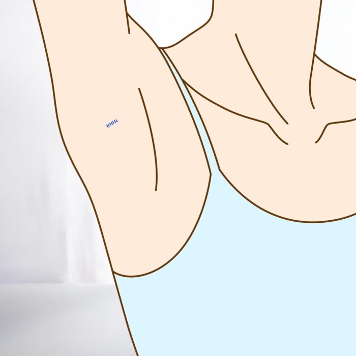 脇を縫合しているところ