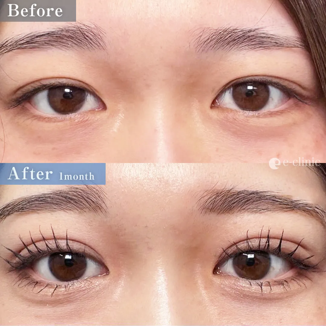 自然癒着法（名医の八木医師が執刀）