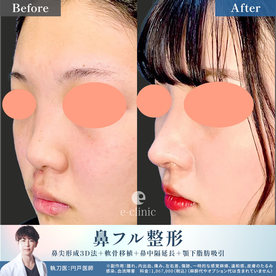 鼻フル整形の症例写真