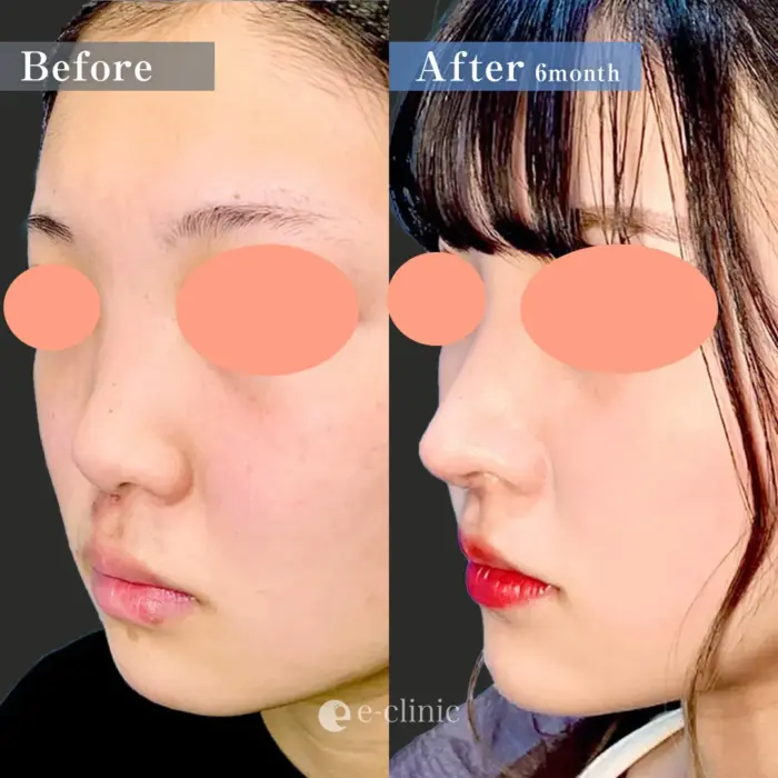 鼻尖形成3D法＋保存軟骨での鼻中隔延長＋鼻尖部軟骨移植＋顎下脂肪吸引（ウルトラZ）（名医の円戸望医師が執刀）