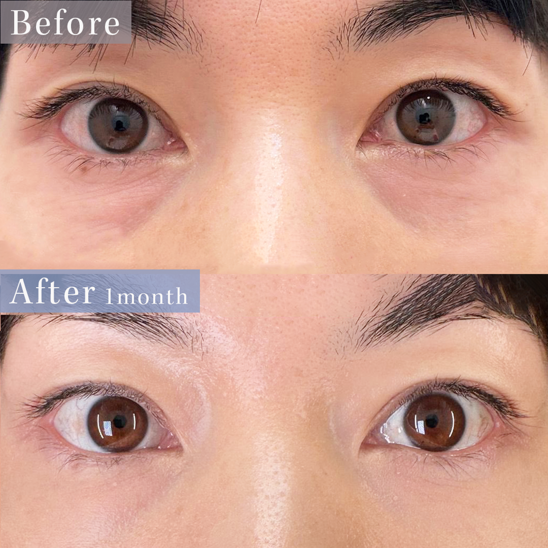 他院修正目の下脂肪注入（ゴルゴ含む）（名医の島田医師が執刀）