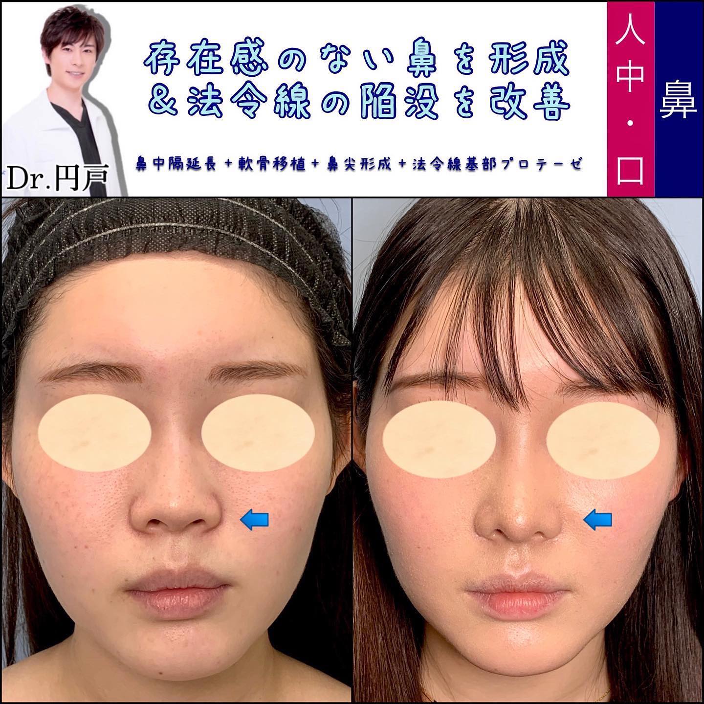 鼻中隔延長と軟骨移植と鼻尖形成と貴族手術の症例写真