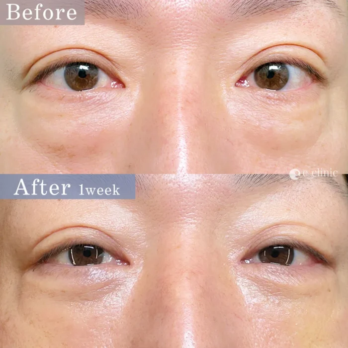 クマ取り経結膜脱脂＋脂肪注入_田嶋隼也医師が執刀（127）