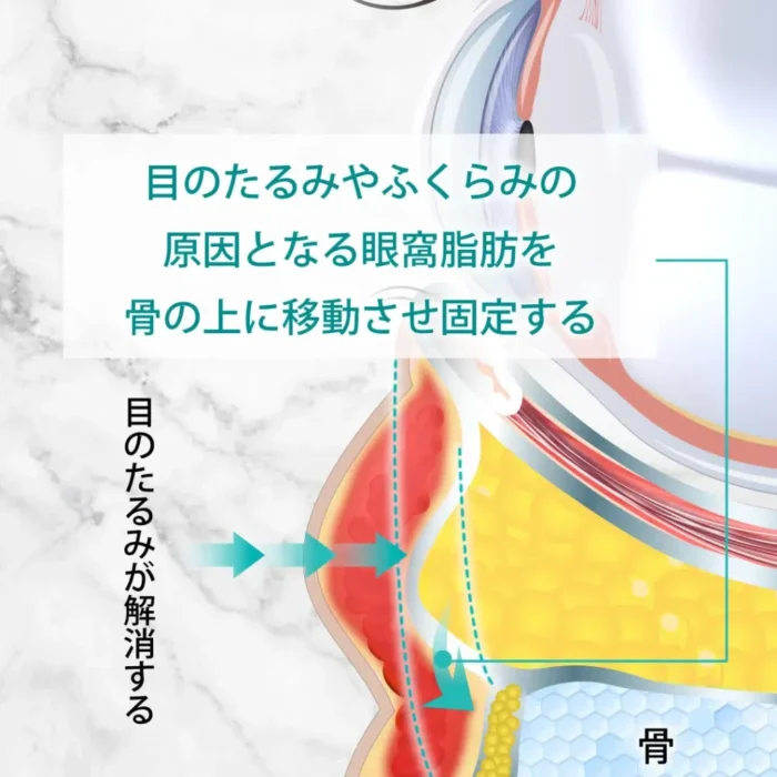 eクリニックのクマ取り 裏ハムラ法症例の図解