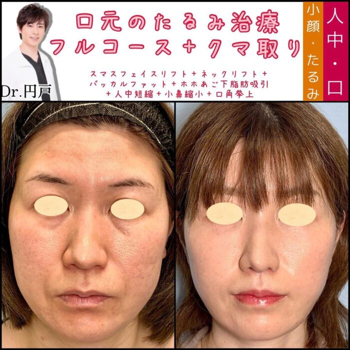 フェイスリフトとバッカルファットと頬顎下の脂肪吸引と人中短縮と小鼻縮小と口角挙上の症例写真