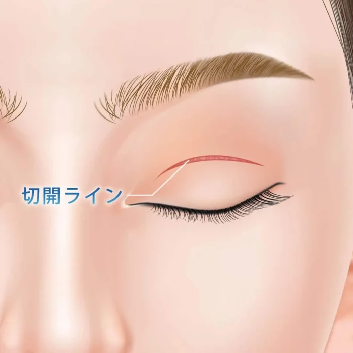 二重切開法の図解