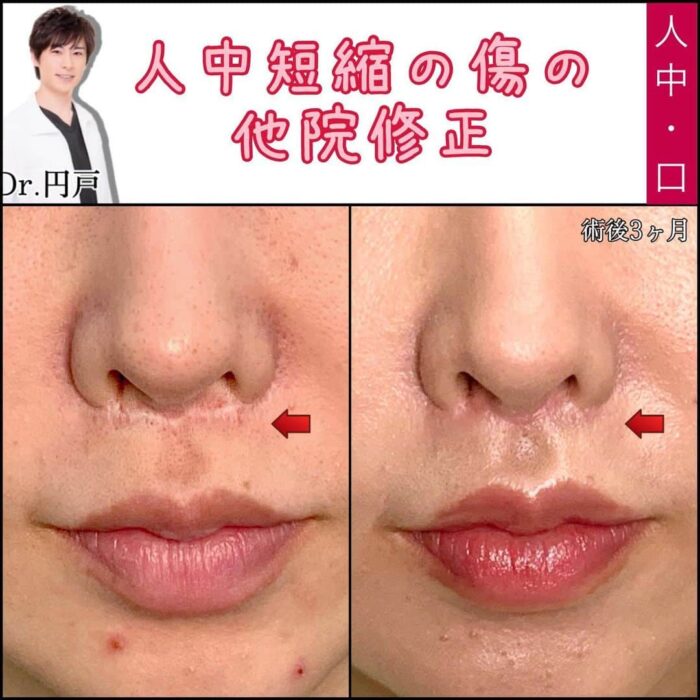 人中短縮の傷の他院修正の症例写真