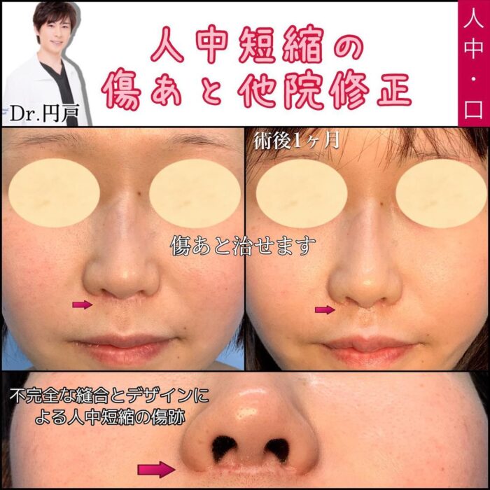 人中短縮の傷痕の他院修正の症例写真