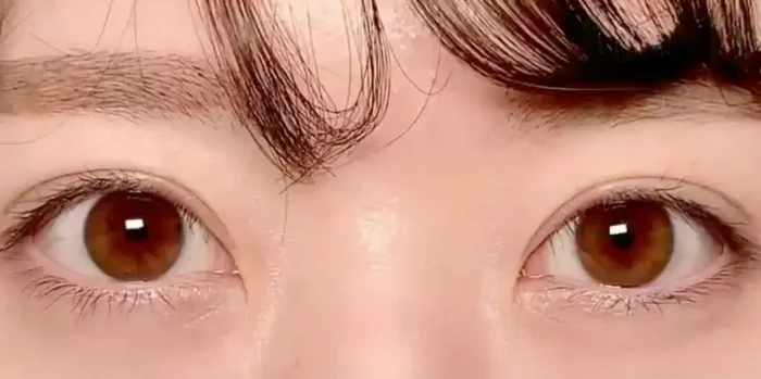 全切開二重術＋眼瞼下垂_名医の円戸望医師が執刀（105）