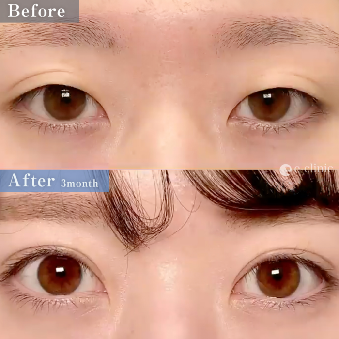 全切開二重術・眼瞼下垂_（名医の円戸望医師が執刀）（105）