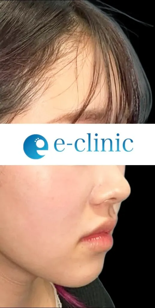 全顔整形（脂肪注入＋脂肪吸引＋鼻フル＋目尻切開）（名医の円戸望医師が執刀）（155）