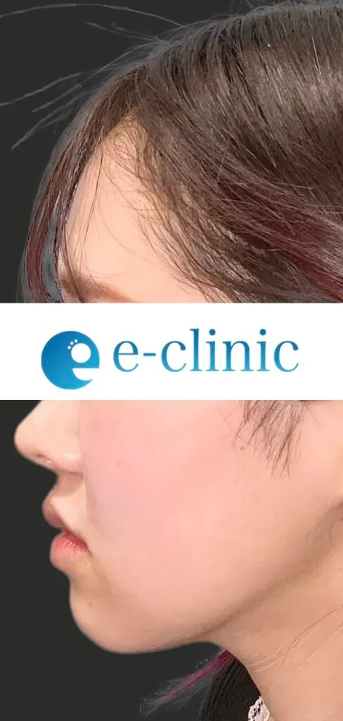 全顔整形（脂肪注入＋脂肪吸引＋鼻フル＋目尻切開）（名医の円戸望医師が執刀）（155）