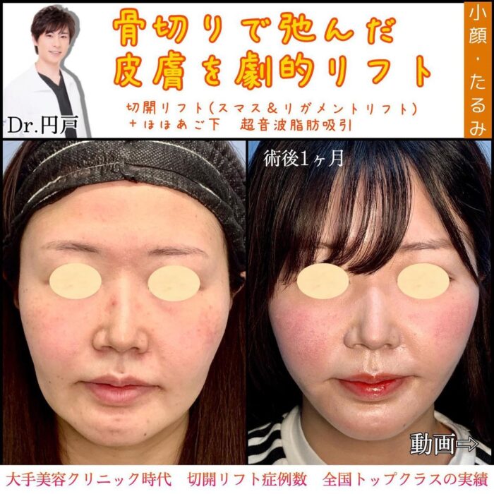 切開リフトとほほと顎下の脂肪吸引の症例写真
