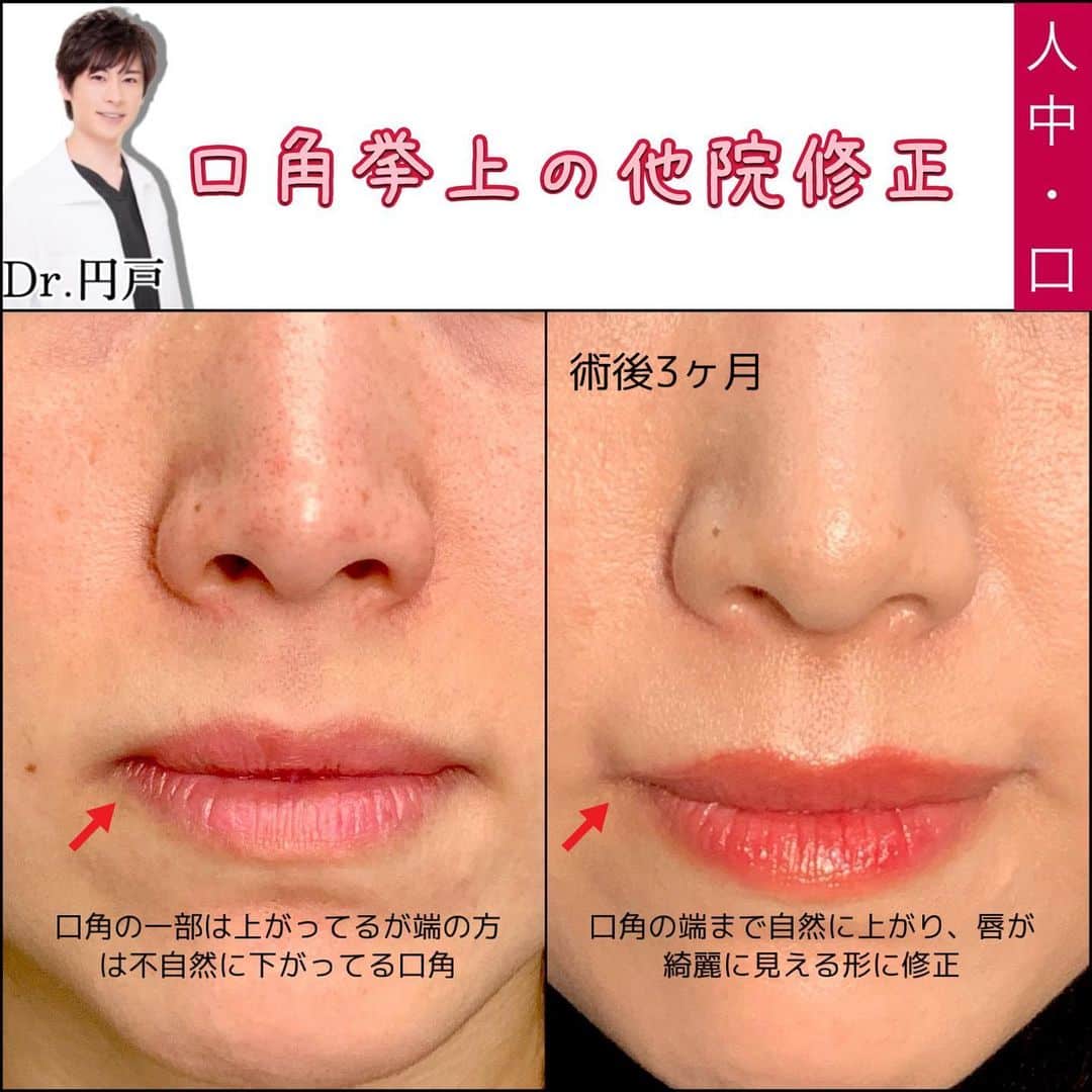 口角挙上の他院修正の症例写真