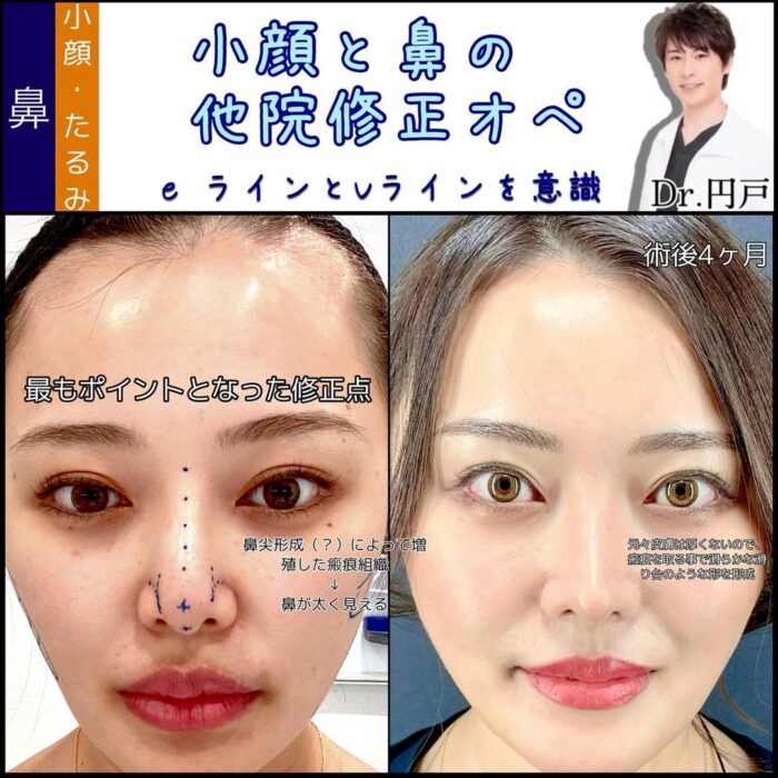 小顔と鼻の他院修正の症例写真