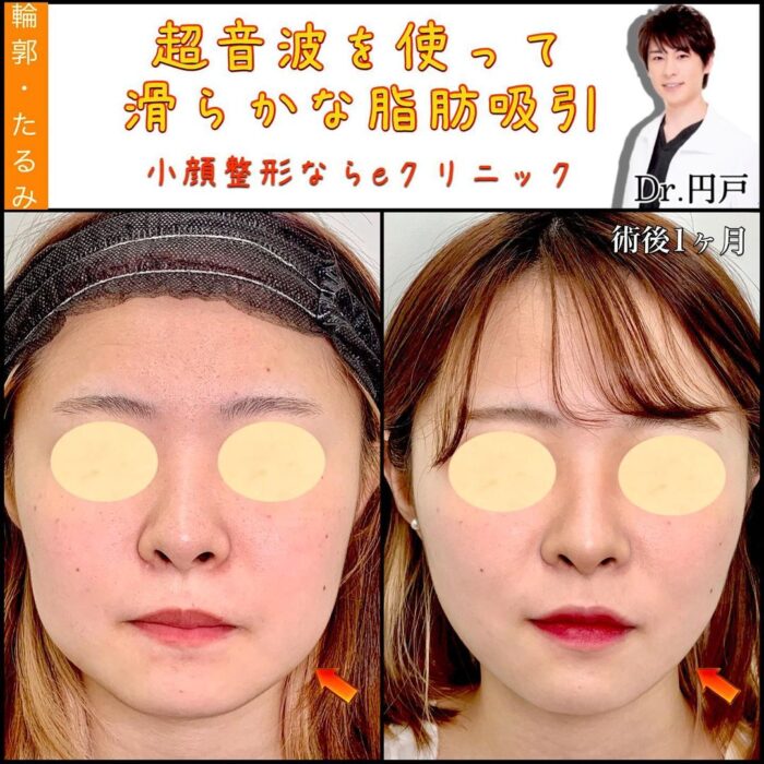 小顔脂肪吸引の症例写真（円戸）