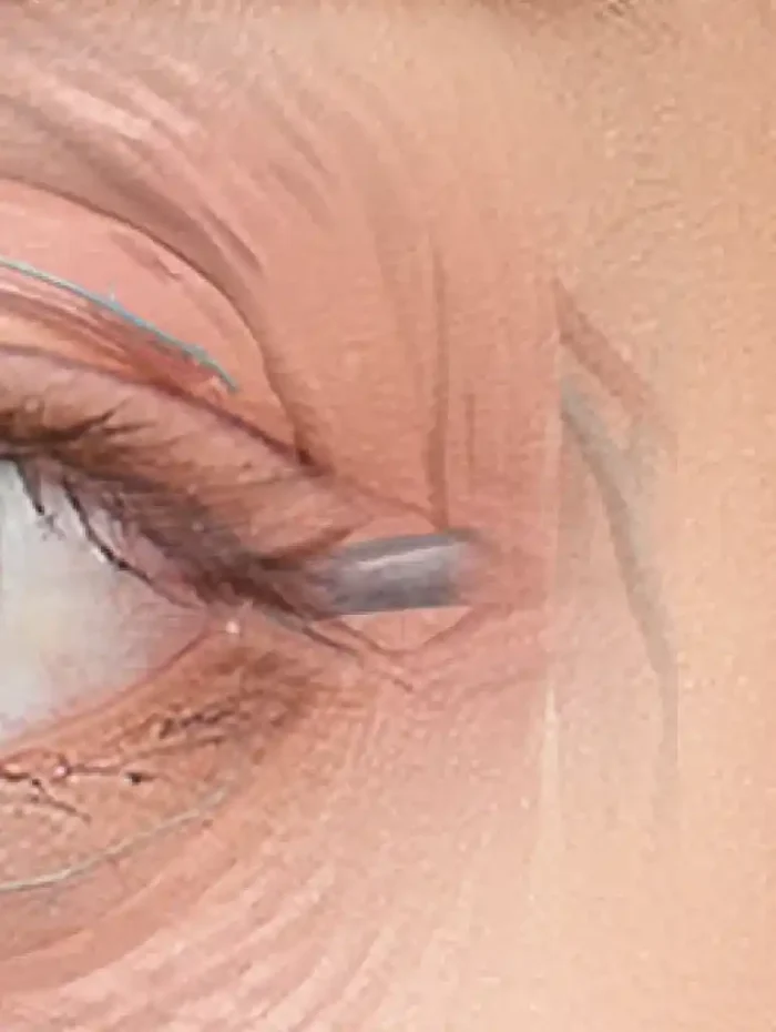 目尻切開（靱帯切開、靱帯移動術）の図解