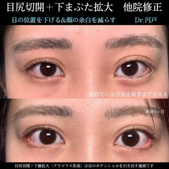 目尻切開とタレ目（グラマラス）形成と他院修正の症例写真