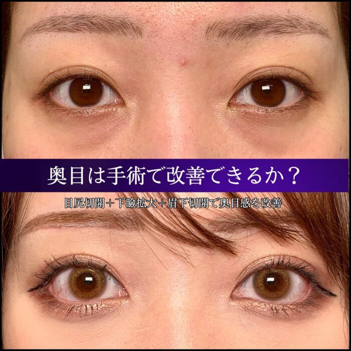 目尻切開と下瞼拡大と目尻切開の症例写真 (1)