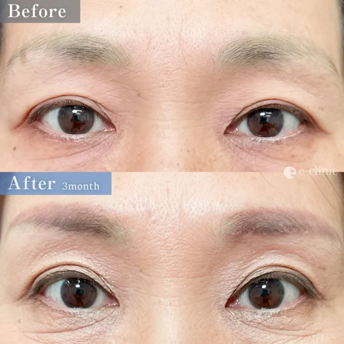 eクリニックの眉下切開（名医の伊藤渉医師が執刀）