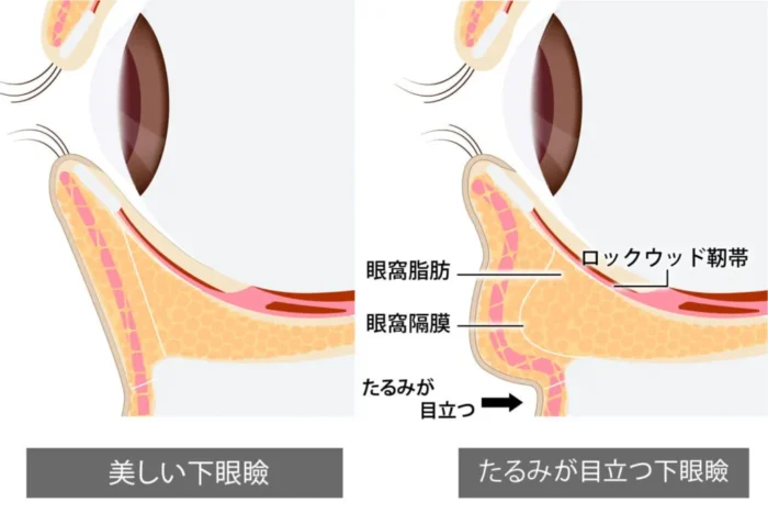 eクリニックのクマ取り眼窩脂肪の図解