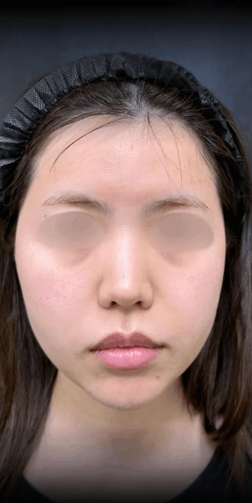 eクリニックの糸リフトの症例術前写真（名医の脇谷雄一朗医師が執刀）