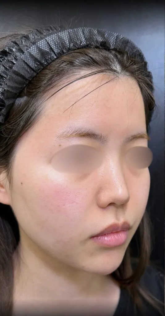 eクリニックの糸リフトの症例術前写真（名医の脇谷雄一朗医師が執刀）