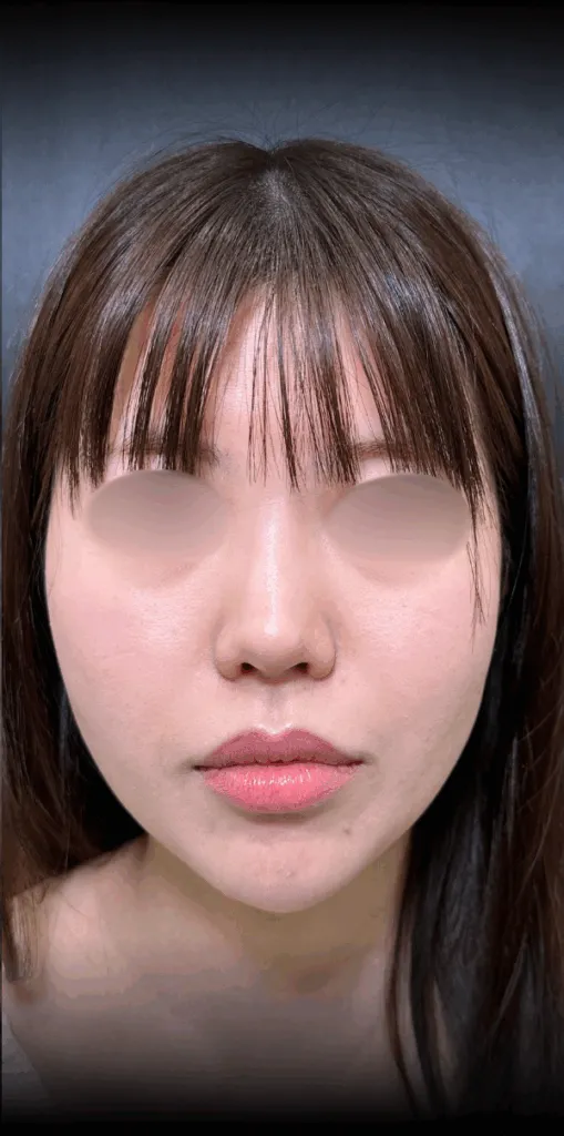 eクリニックの糸リフトの症例術後写真（名医の脇谷雄一朗医師が執刀）