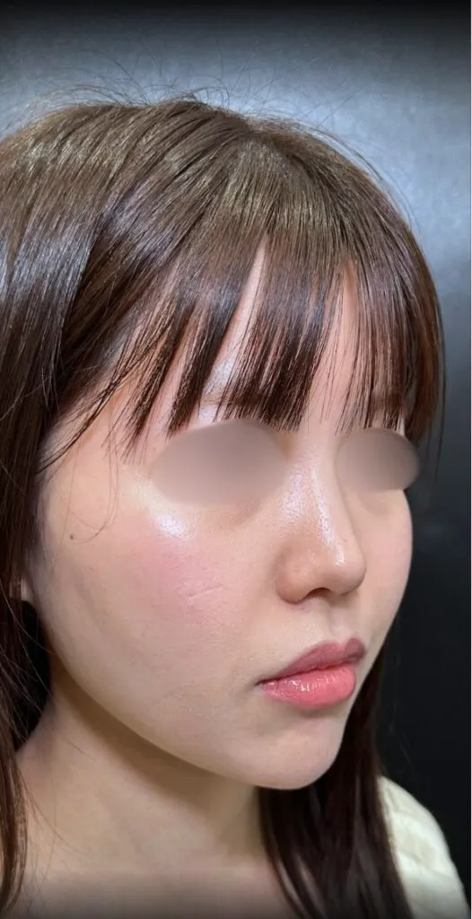 eクリニックの糸リフトの症例術後写真（名医の脇谷雄一朗医師が執刀）